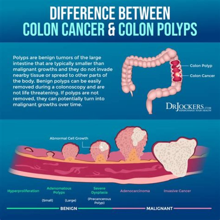 Are large colon polyps usually cancerous?