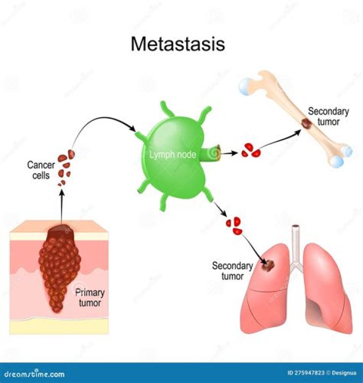 Can a small tumor metastasis?