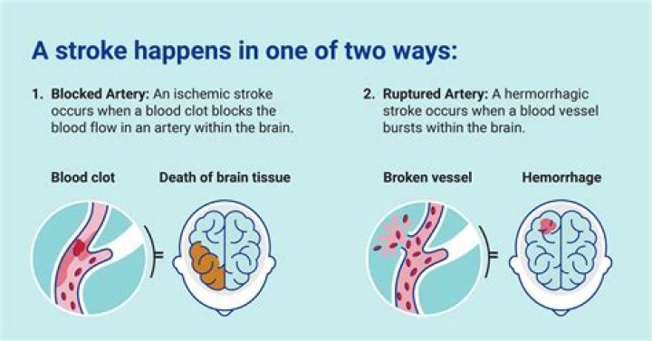 Can a stroke affect your vagina?