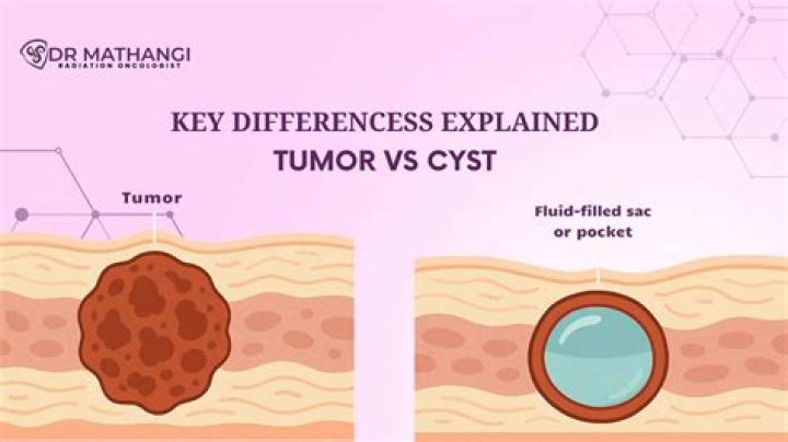 Can an MRI tell the difference between cyst and tumor?