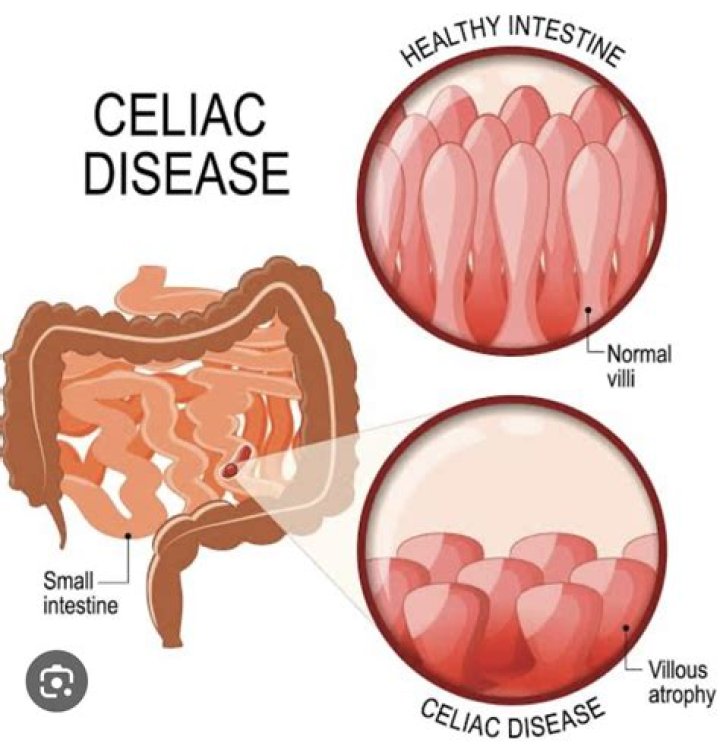 Can celiac disease affect your spleen?