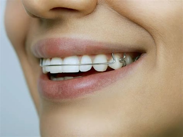 Can I chew gum with a retainer?