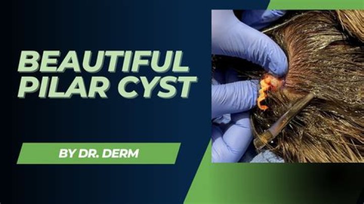 Can I pop a pilar cyst?