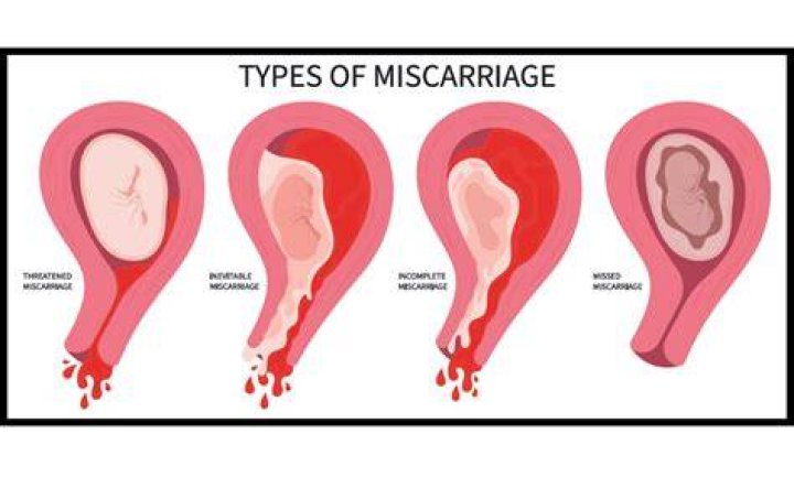 Can I take bath after miscarriage?