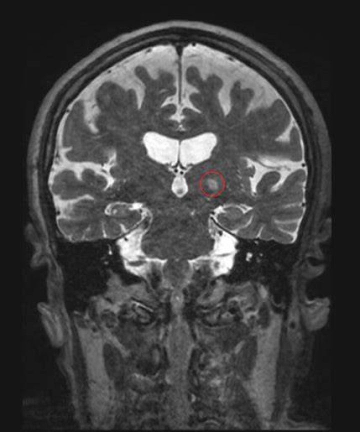 Can MRI detect essential tremor?