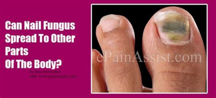 Can nail fungus spread to other parts of the body?