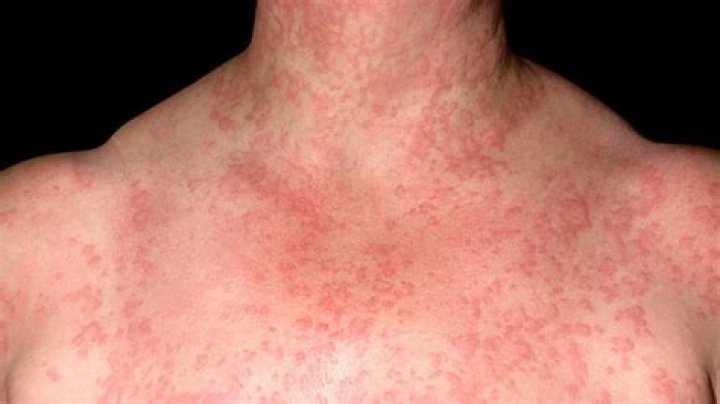 Can u be allergic to water?