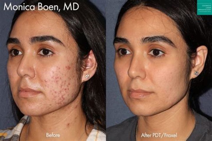 Can Vaseline remove scars?