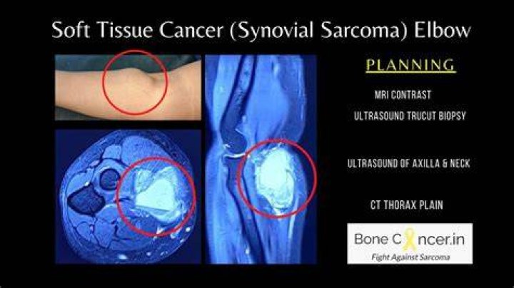 Can you feel soft tissue sarcoma?