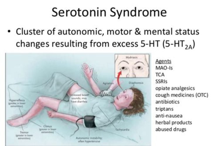 Can you have a mild case of serotonin syndrome?