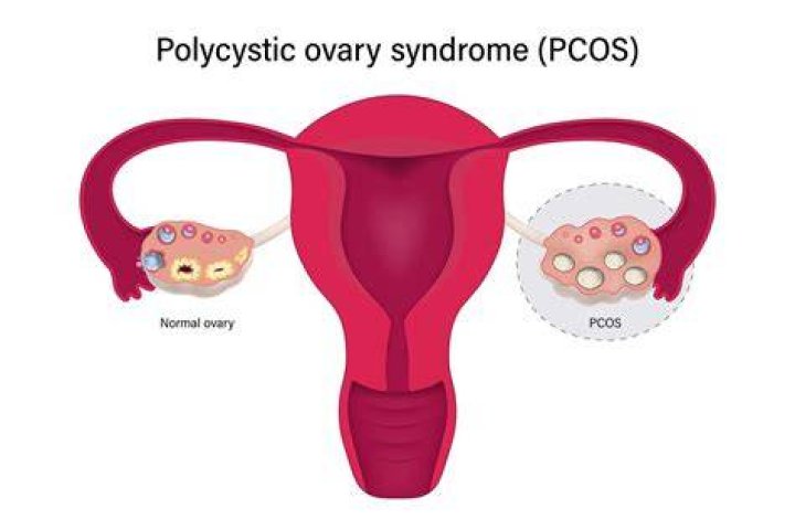 Can you have ovarian cysts without PCOS?