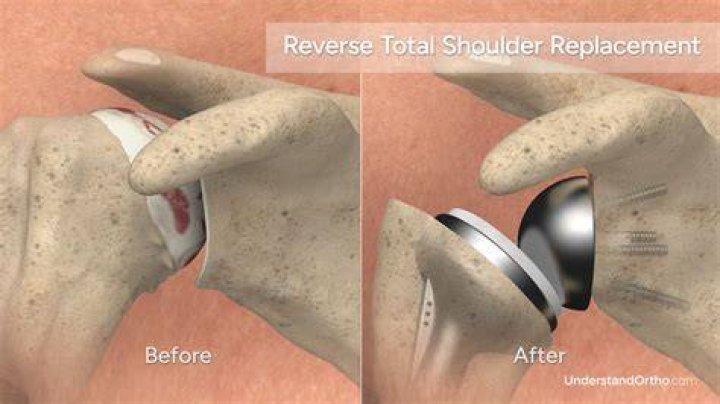 Can you reach behind your back after reverse shoulder replacement?