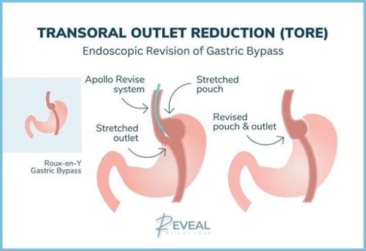 Can you reverse gastroparesis?