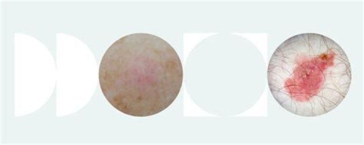 Do amelanotic melanomas itch?