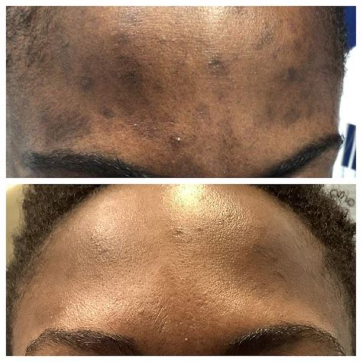 Does aloe vera fade hyperpigmentation?