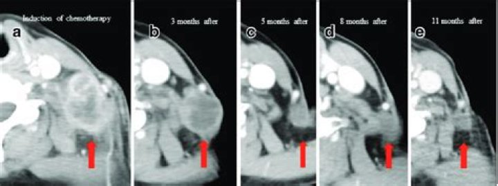 Does chemo shrink tumors?