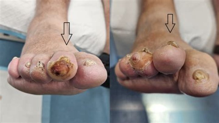 Does Debbie get her toes cut off?