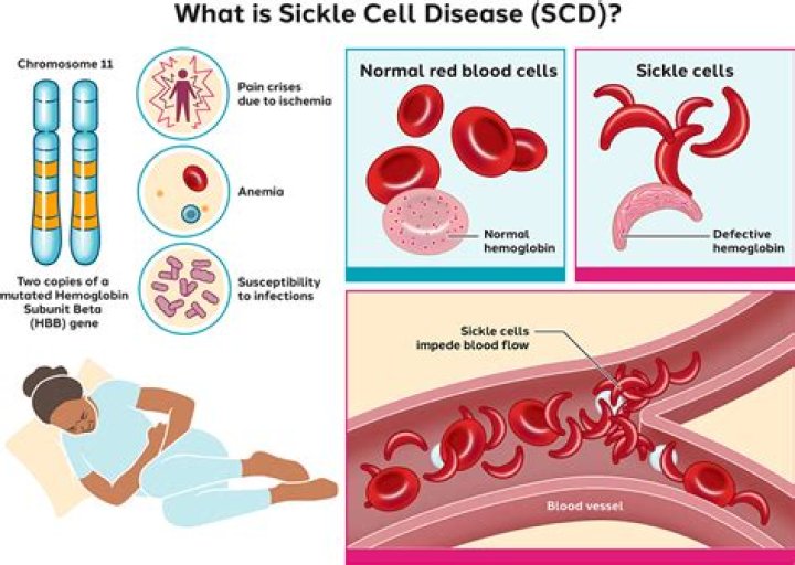 Does deletion cause sickle cell anemia?