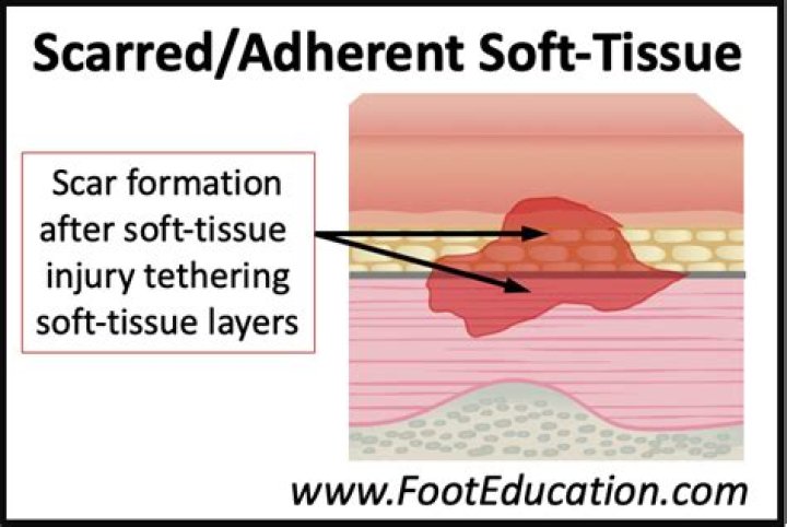 Does heat help scar tissue?