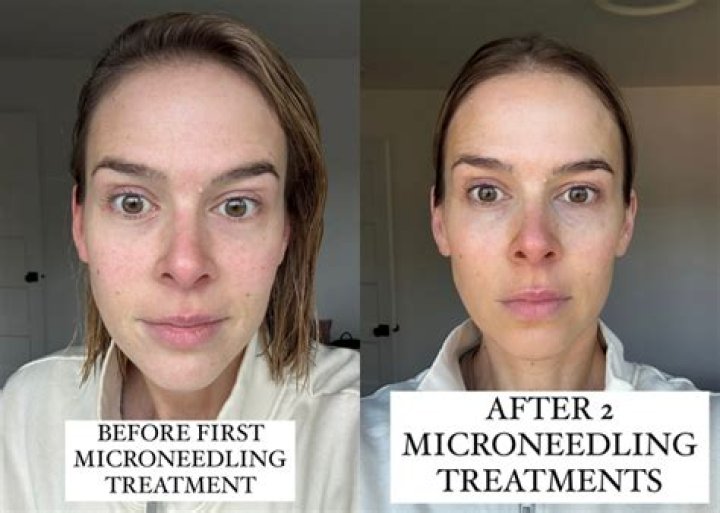 Does microneedling cause wrinkles?