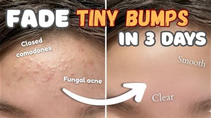 How do I get rid of the little bumps on my cheeks?