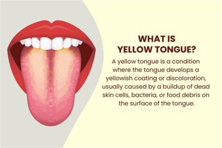 How do I get rid of yellow coating on my tongue?