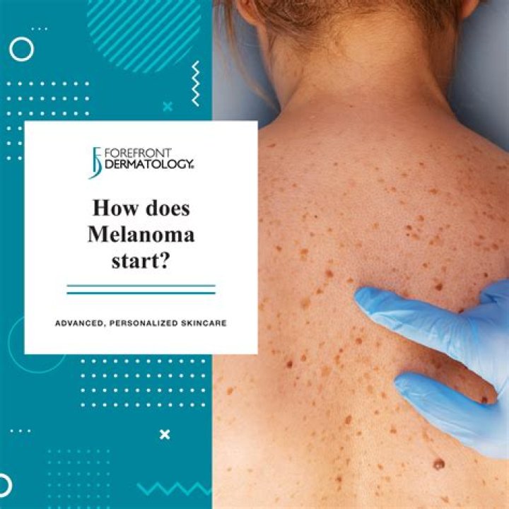 How do I know if melanoma has spread?