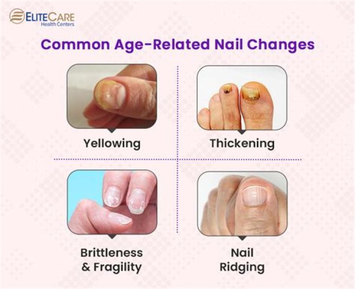 How do you treat aging nails?