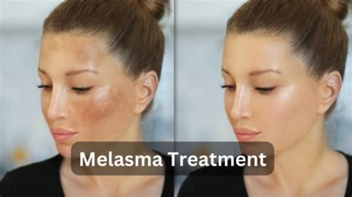 How I cured my melasma?