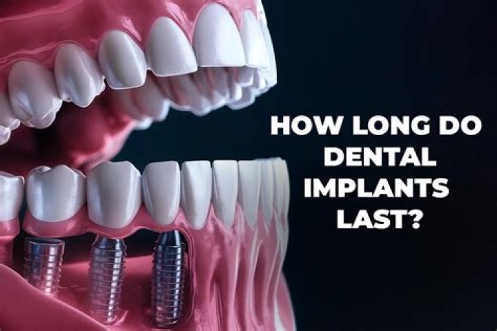 How long do lens implants last?