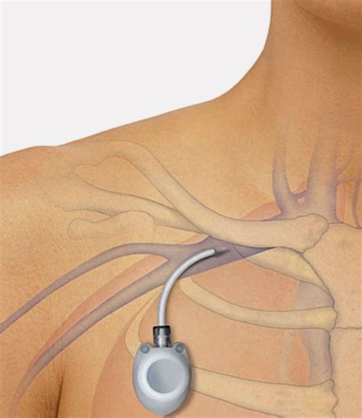 How long does port surgery take?