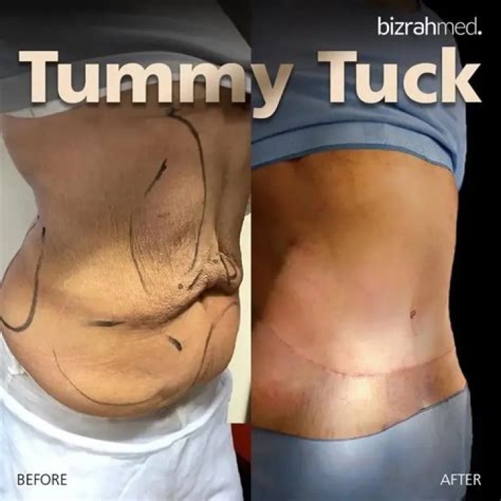 How long will a tummy tuck last?