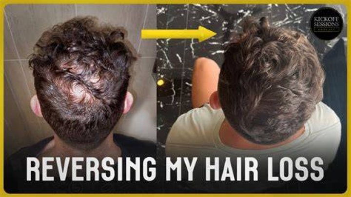 Is hair loss reversible?