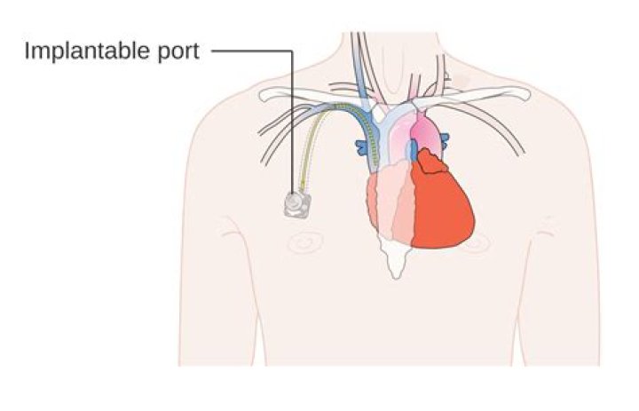 Is having a port put in painful?