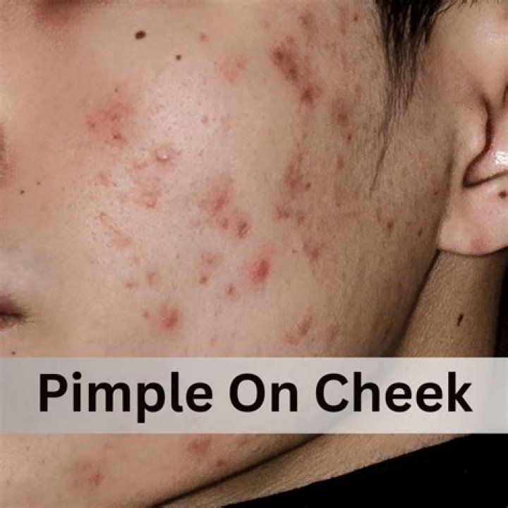 What are crush pimples?