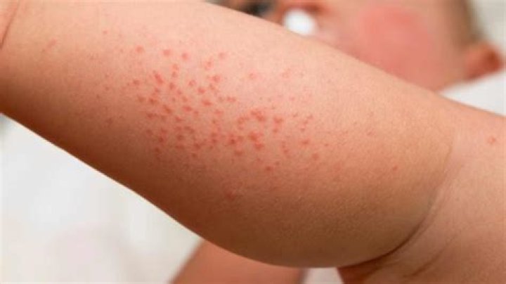 What can be mistaken for heat rash?