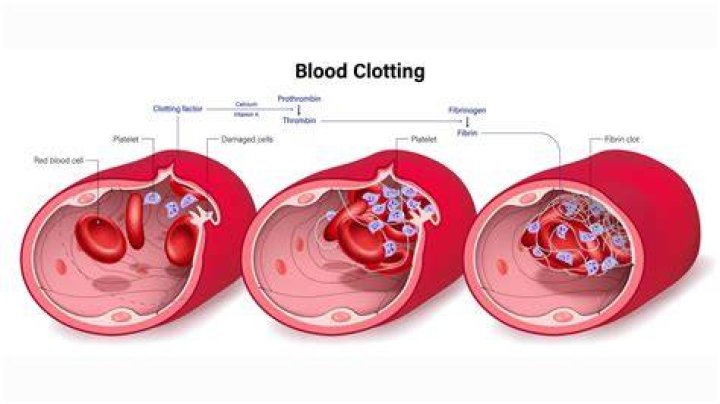 What cancers cause blood clots?