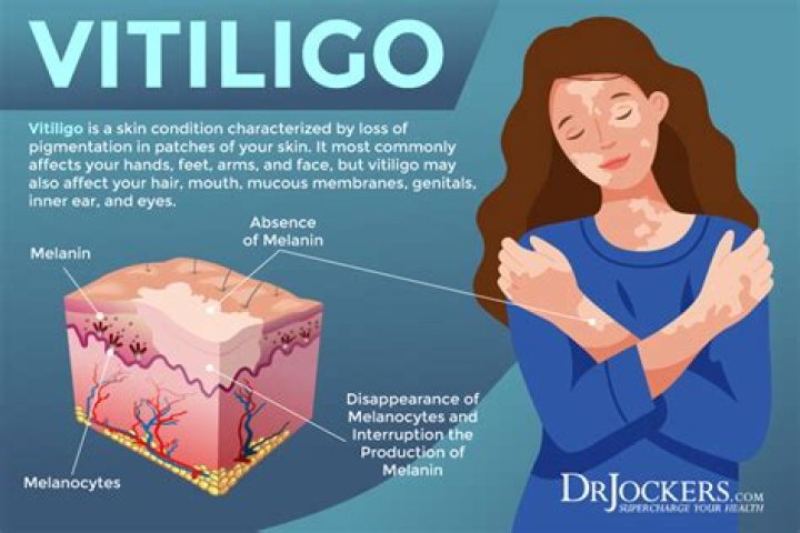 What causes vitiligo later in life?