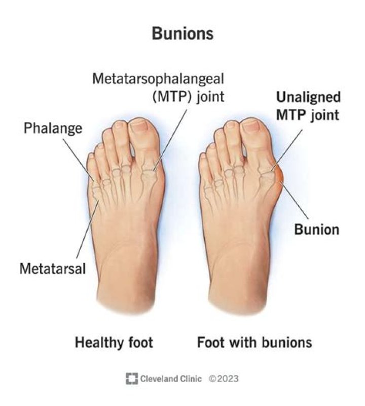 What do bunions do to your body?