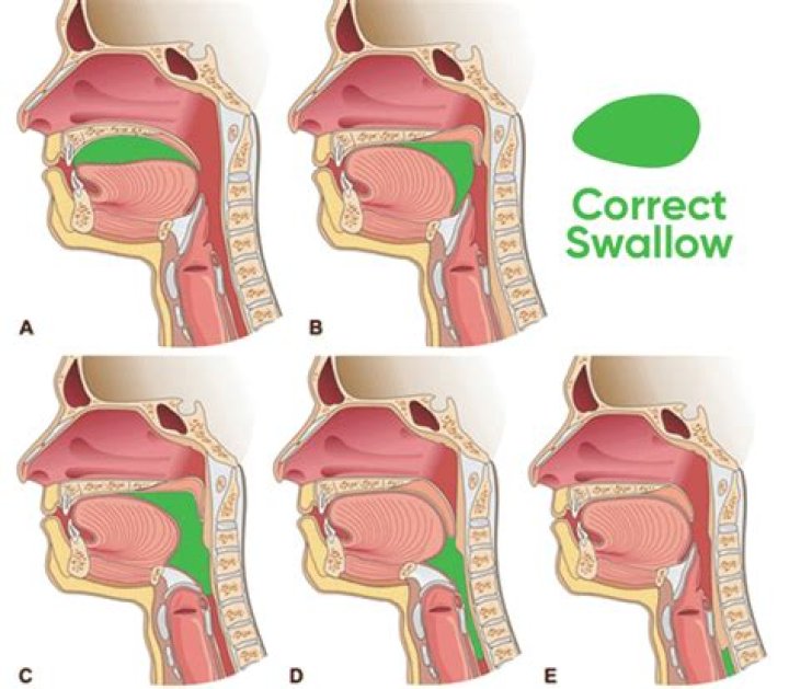 What do I do if I swallow my crown?