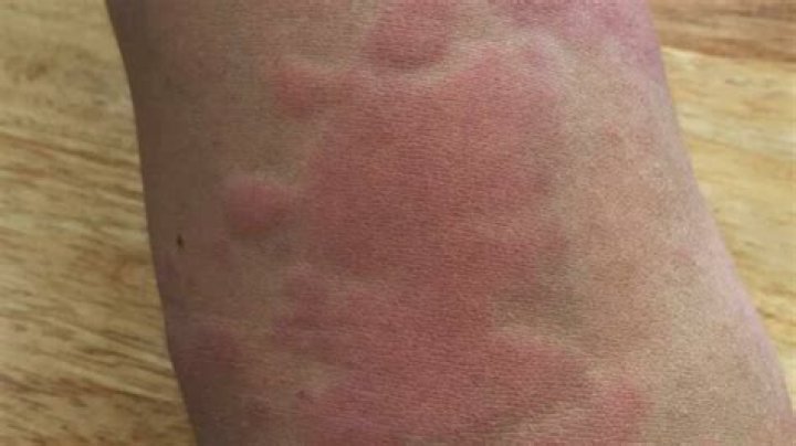 What does a bacterial rash look like?