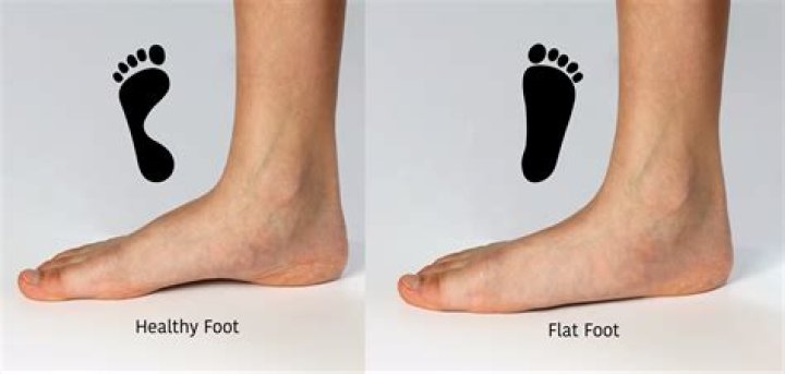 What does flat feet do to your knees?