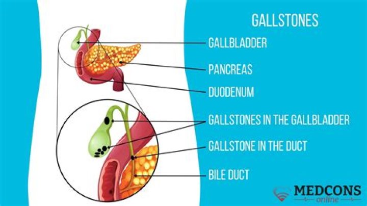 What does passing a gallstone feel like?