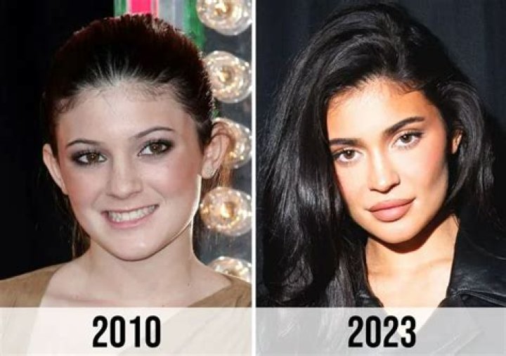 What eye surgery did Kylie?