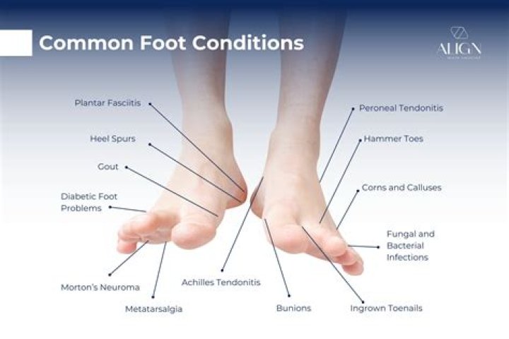 What happens if flat foot goes untreated?