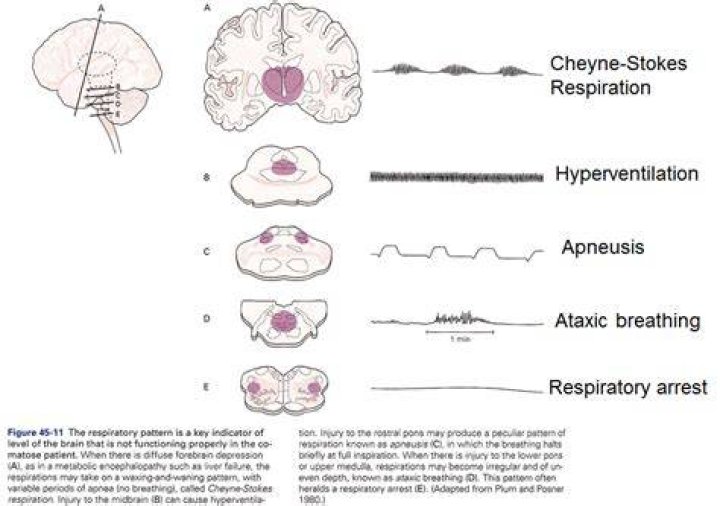 What is ataxic respiration?