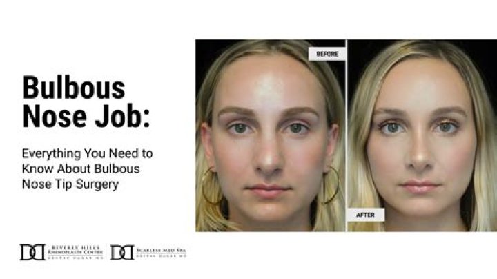 What is bulbous nose?