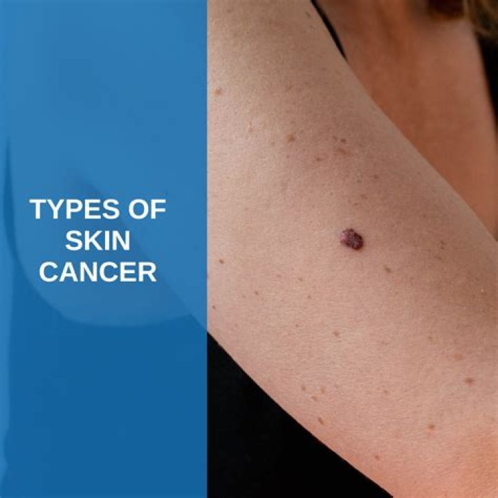 What is pre cancerous skin?