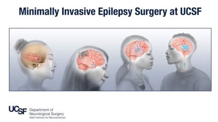 What is the cost of epilepsy surgery?