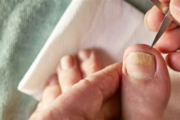 What kind of doctor removes toenails?